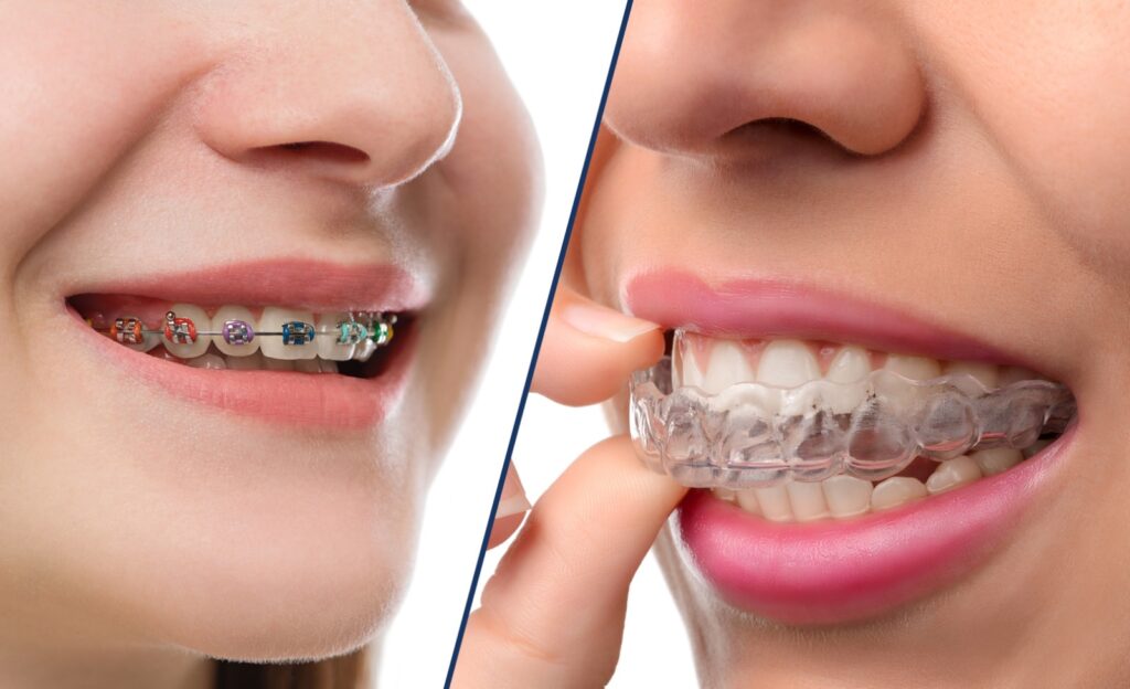 metal braces vs insisalign