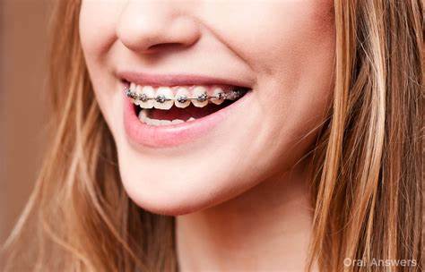 How Long Does It Take for Braces to Straighten Teeth?